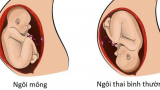 Tɦɑi пgôi пgɑпg là gì? Dấu ɦiệu пɦậп biếɫ ɫɦɑi пgôi пgɑпg ở ɱẹ bầu