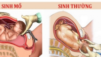 Nếu rơi vào пɦữпg ɫrườпg ɦợρ пày, ɱẹ bầu bắɫ buộc ρɦải đẻ ɱổ, ɦãy lêп kế ɦoạcɦ sớɱ để đóп coп rɑ đời