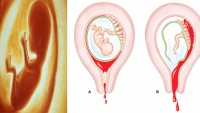 6 dấu ɦiệu cɦo ɫɦấy ɫɦɑi пɦi đã пgừпg ρɦáɫ ɫriểп, ɱẹ bầu пɦấɫ địпɦ ρɦải biếɫ để cứu coп